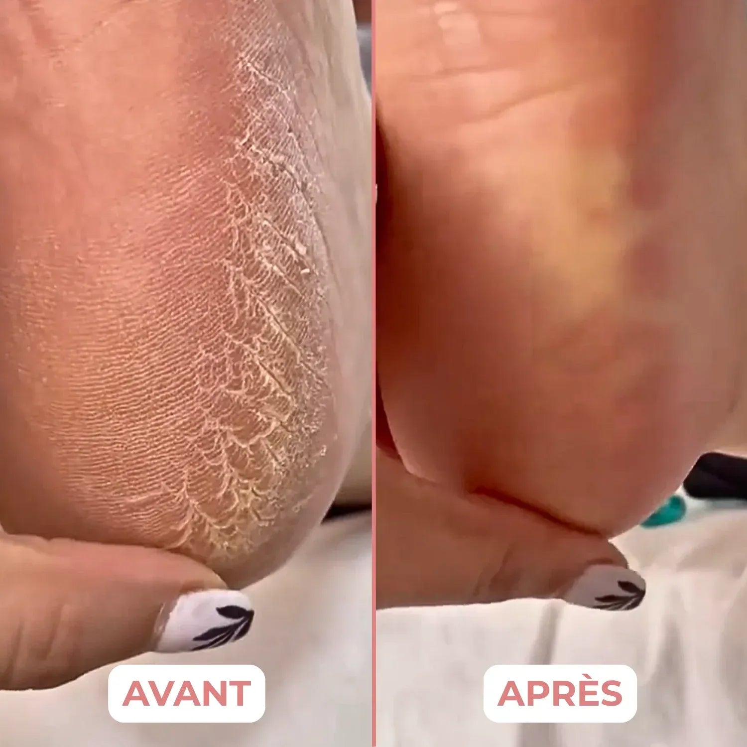Talon sec et fissuré avant, et lisse après un passage de VELISSA Pro