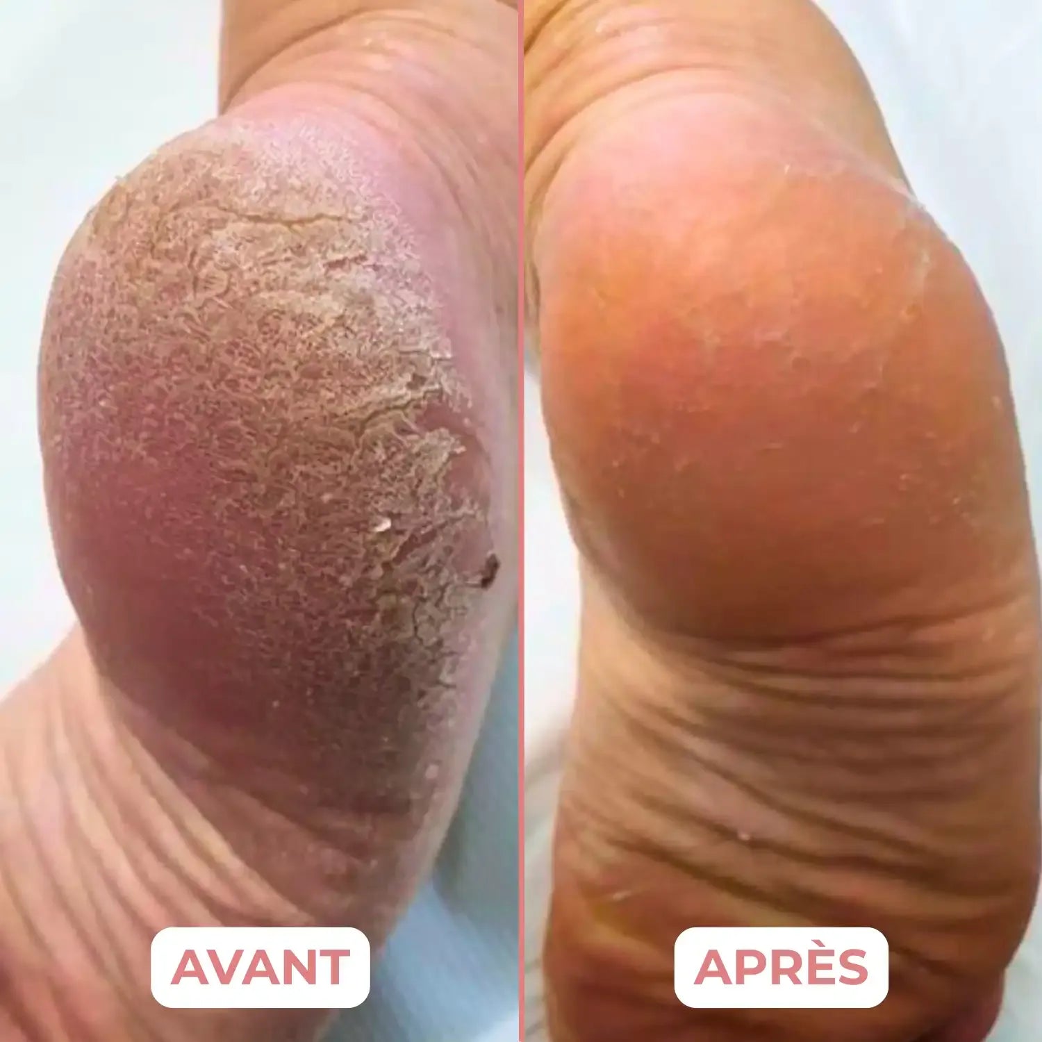 Talon très corné avant, et lisse après un passage de B-LIME Pro