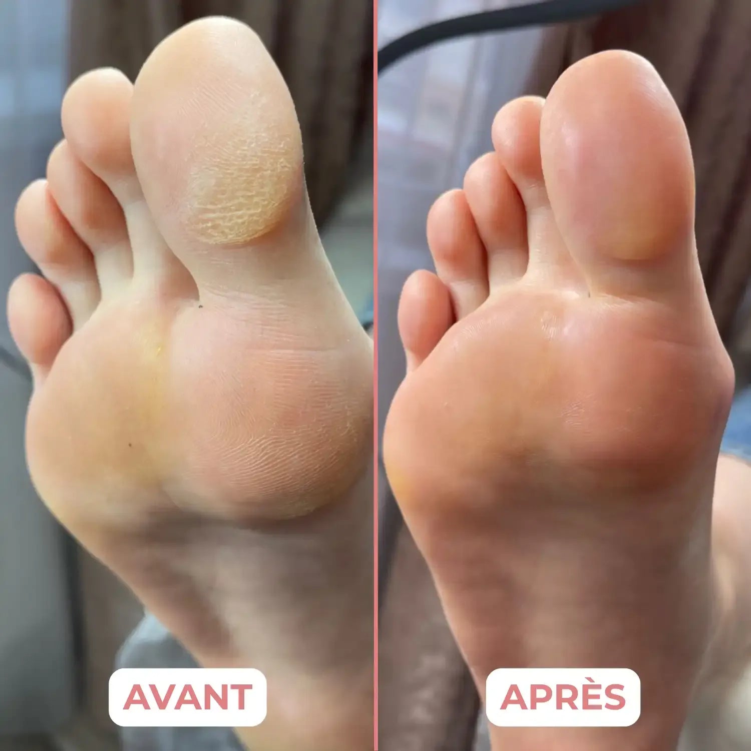 Avant-pied avec callosité avant, et lisse après un passage de B-LIME Pro